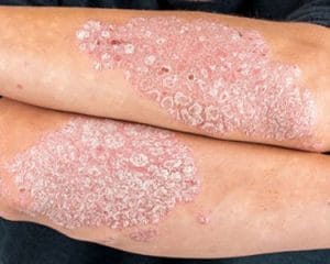 Adult with psoriasis on their arms
