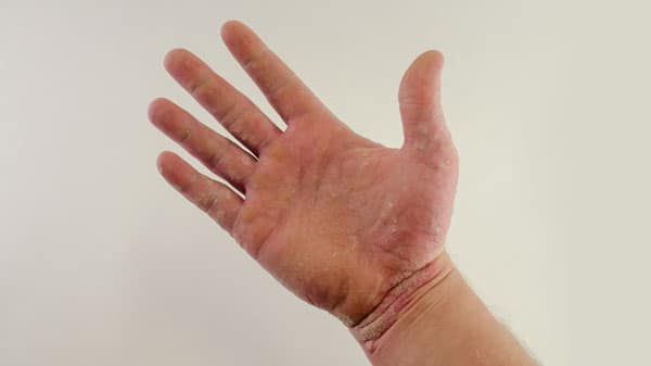 Psoriasis on the palm of a hand
