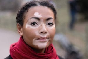 Women diagnosed with vitiligo wearing a red scarf and a black jacket outside