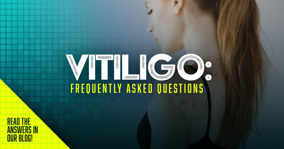 Vitiligo FAQ