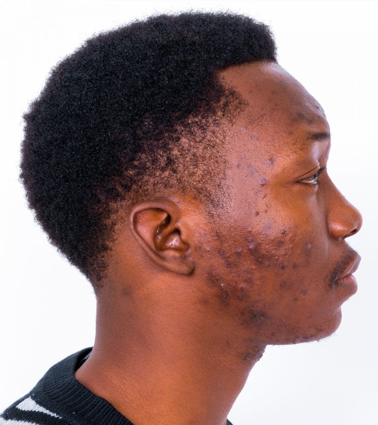 African American with acne on face