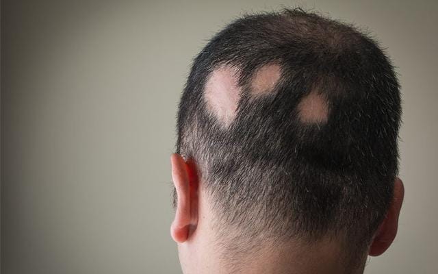 What Causes Alopecia Areata? – IC Research Tennessee