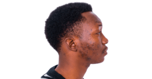 African American with acne on face